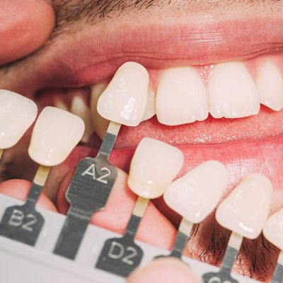 Zahnarzt vergleicht Veneers mit natürlicher Zahnfarbe