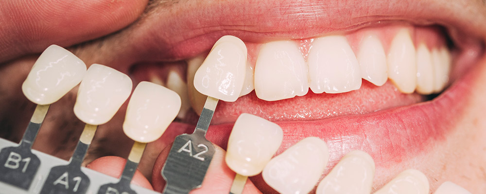 Zahnarzt vergleicht Veneers mit natürlicher Zahnfarbe